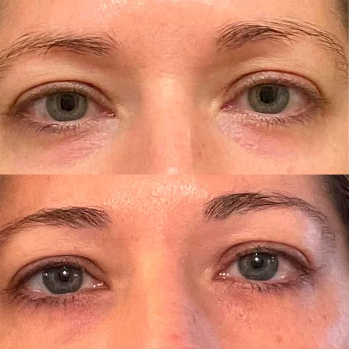 Before and after eye area comparison showing reduced under-eye hollowing and improved skin texture